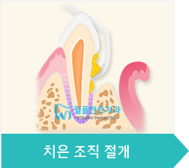 2.치은 조직 절개